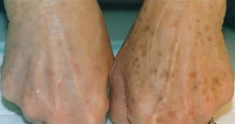 Astuces pour faire partir les taches de vieillesse sur la peau